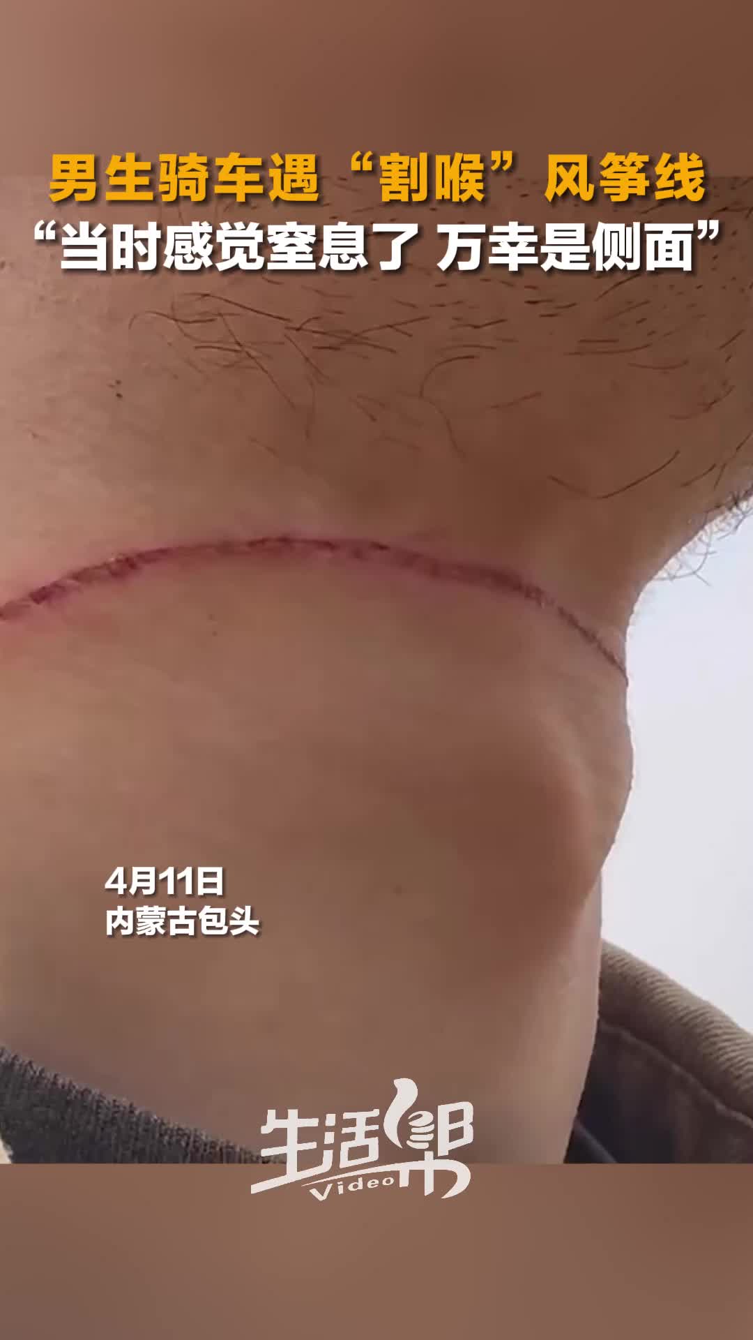 男生骑车遇割喉风筝线当时感觉窒息了万幸是侧面