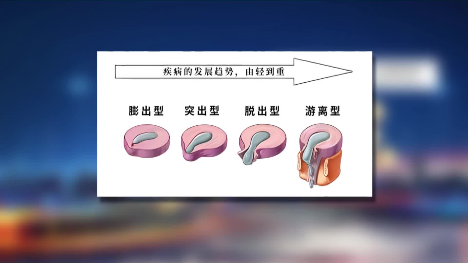 腰椎间盘突出是怎样一步步变严重的?