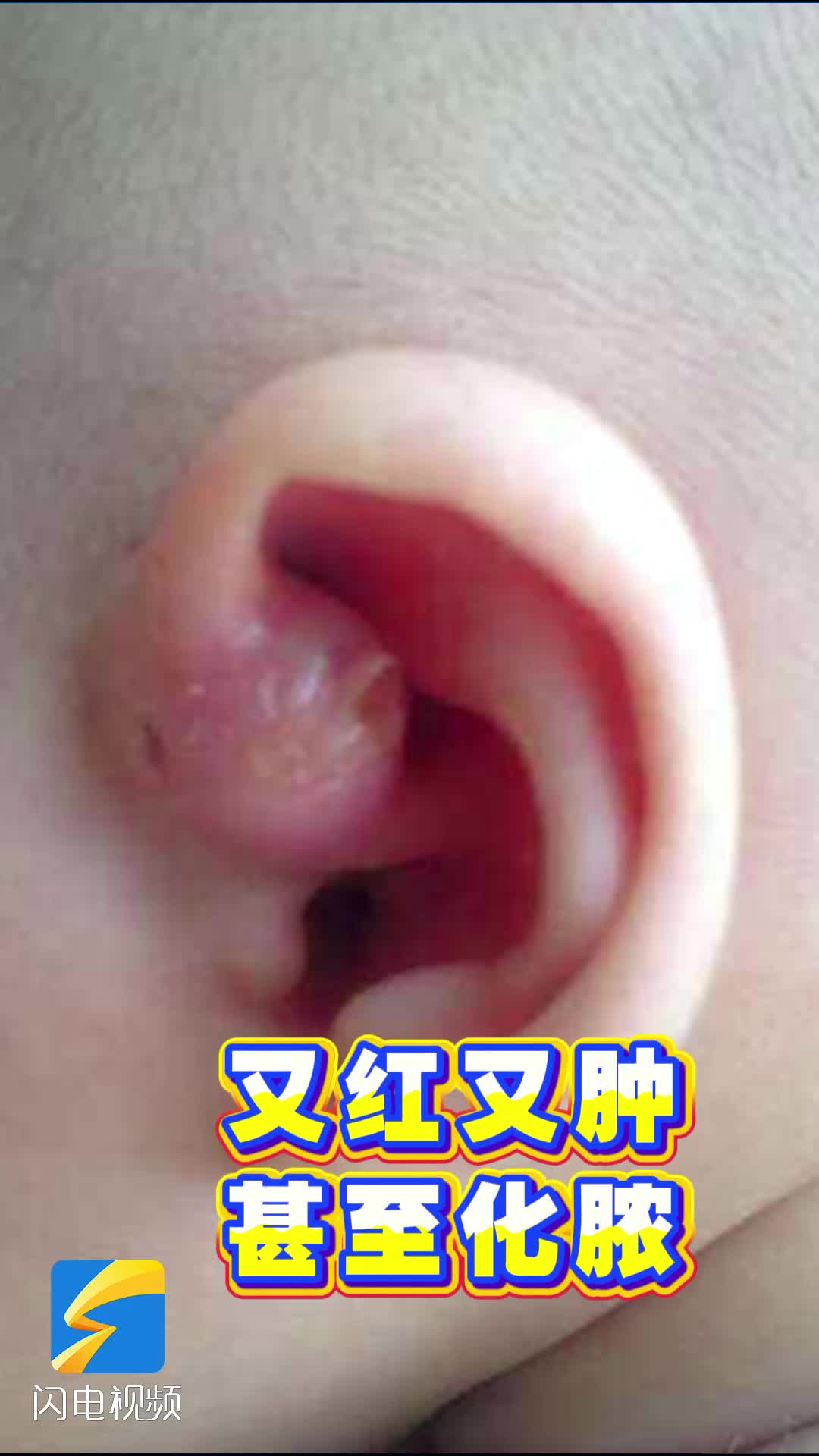 别再信“福气仓”了！耳前这个小孔其实是畸形