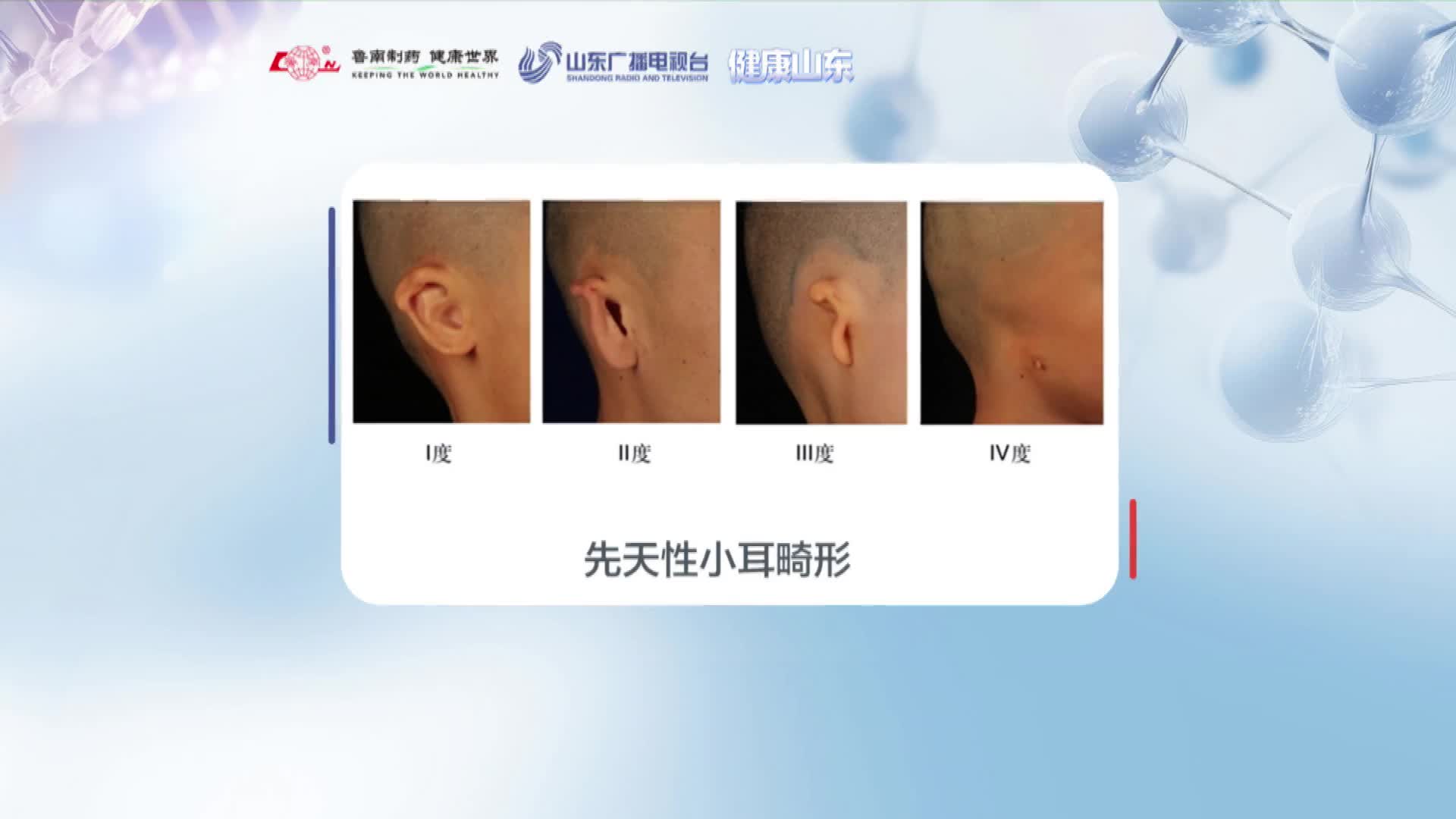 先天性小耳畸形4度分级科普，一看明了