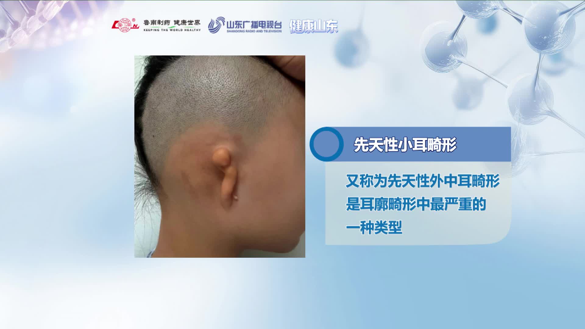 先天性小耳畸形不是“小问题”