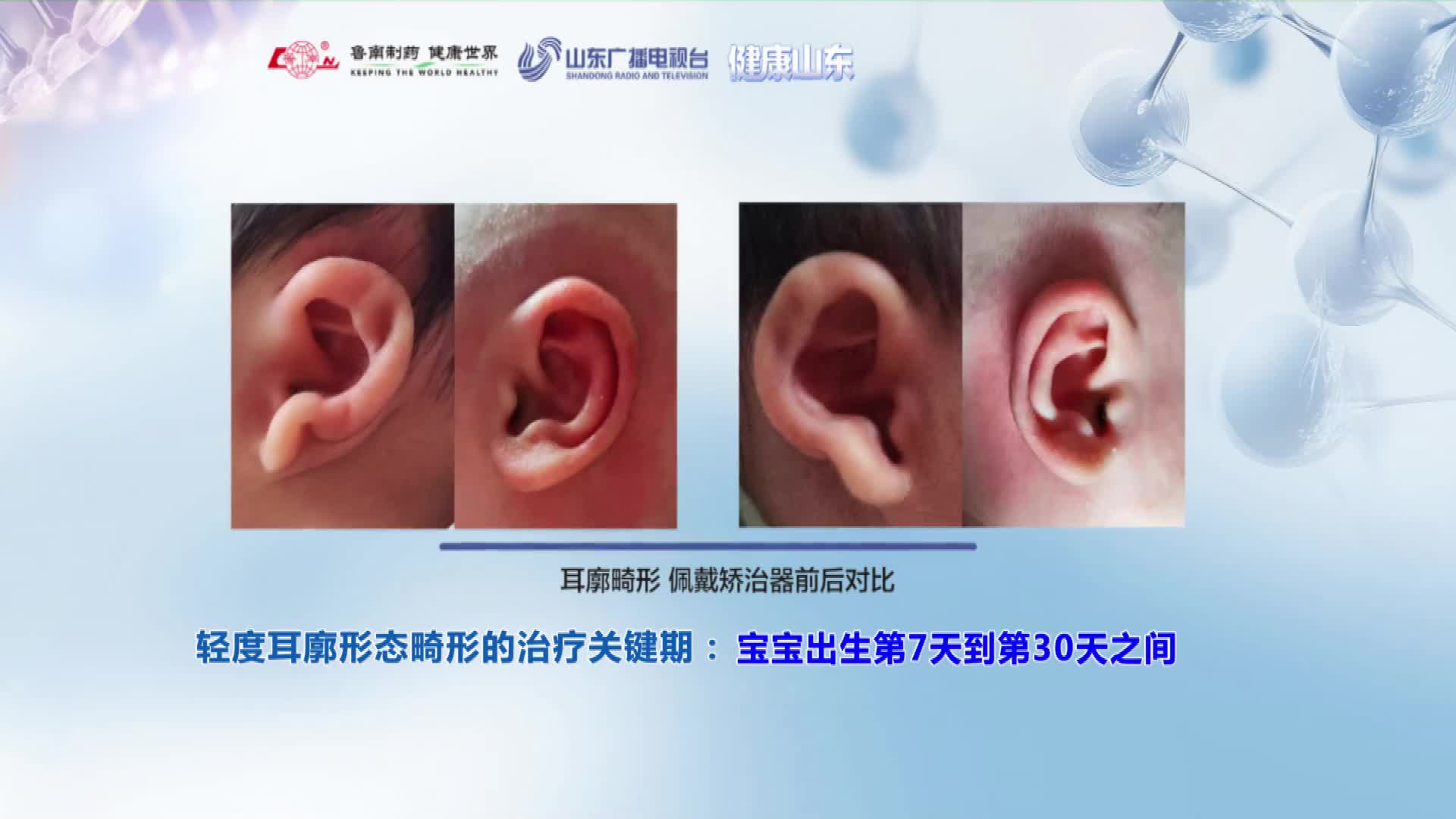 新手家长必看！轻度耳廓畸形黄金矫正时机