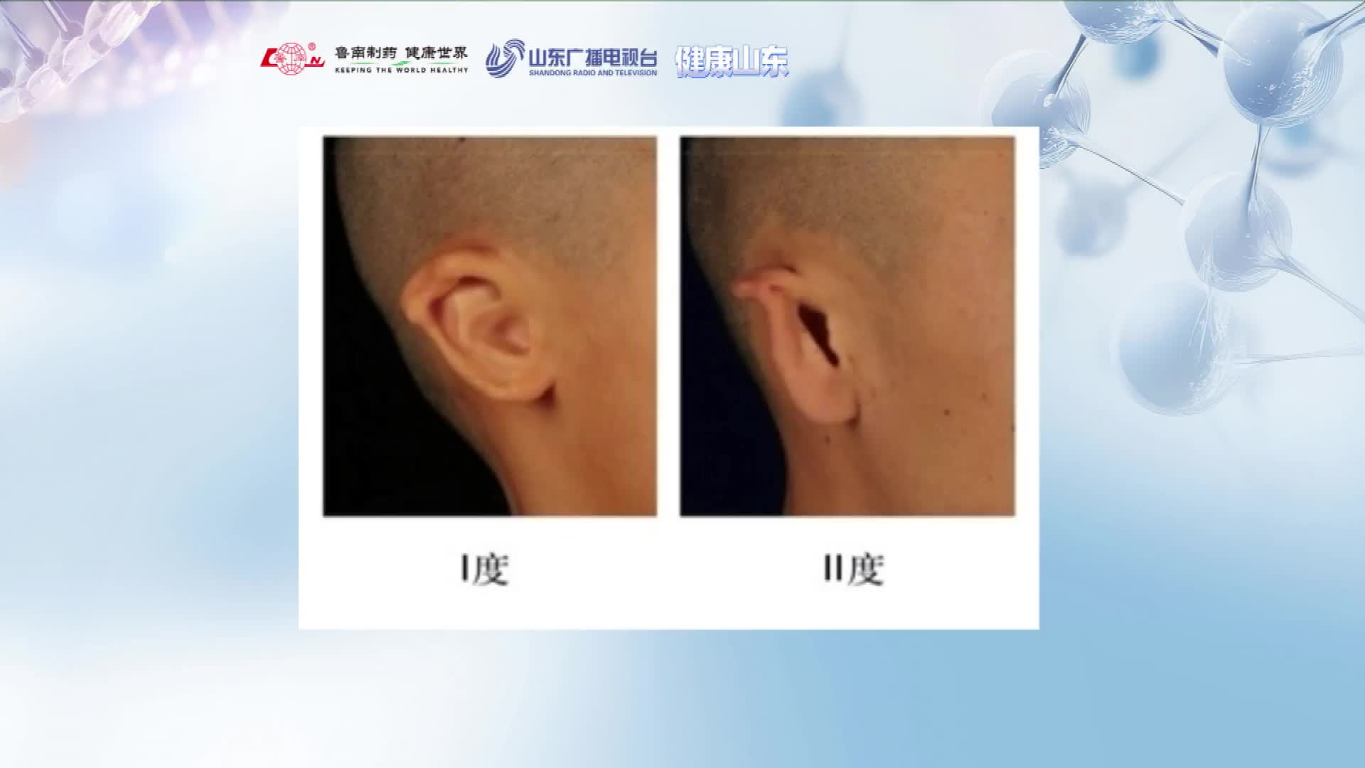 小耳畸形治疗不是“一刀切”！轻度畸形无需手术
