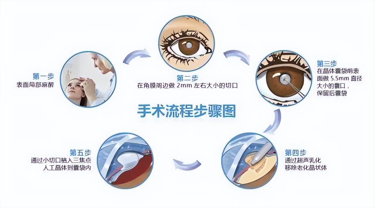 白内障成熟才能做手术错啦